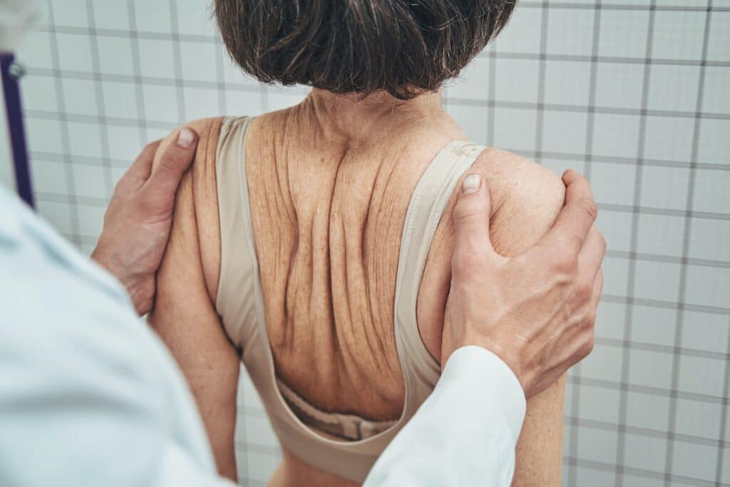 treating scoliosis with chiropractic care